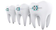 Braces.png