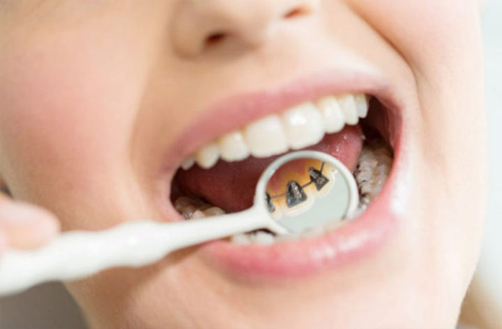 Win_lingual_braces_examination.jpg