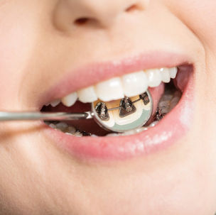 Patient with lingual braces