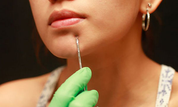 Comedone Extraction