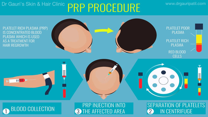 PRP : A Recipe for Hair loss Treatment