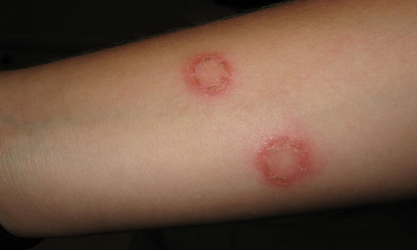 Ringworm Infection