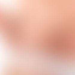 Myths and Facts about Stretch Marks