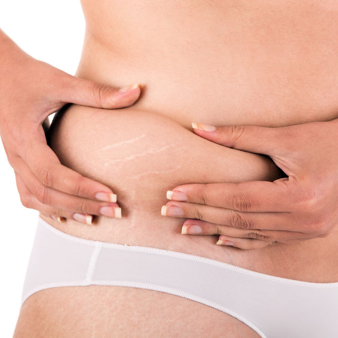 Myths and Facts about Stretch Marks