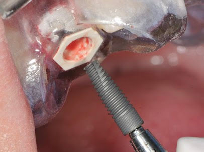 Insertion de l'implant SLIM à travers le guide