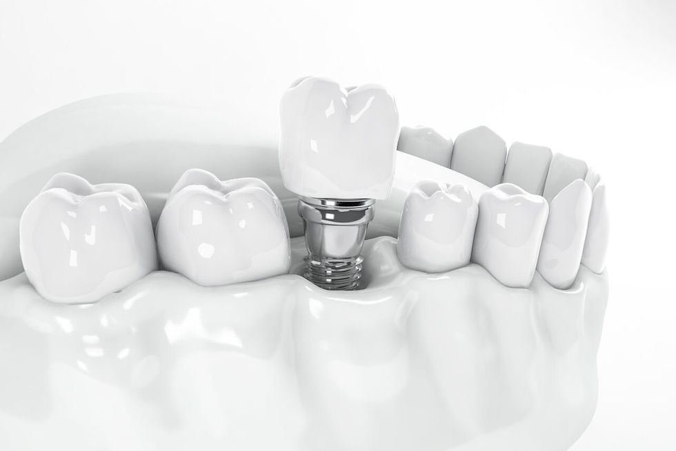 dental-implant-brookline-MA-1280x854-1.jpg
