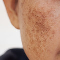 Hyperpigmentation & Melasma