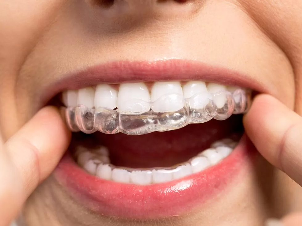 Clear Aligner Treatment with Invisalign: Transparent orthodontic aligners gently shifting teeth into alignment for a confident smile