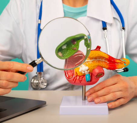 Que son las piedras en la vesícula o colelitiasis: Todo lo que necesitas saber para tomar la mejor decisión