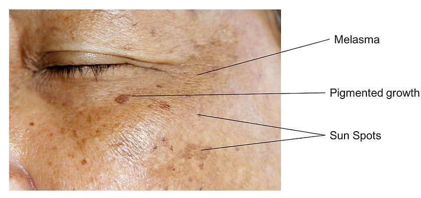 pigmentation-diagram-3.jpg