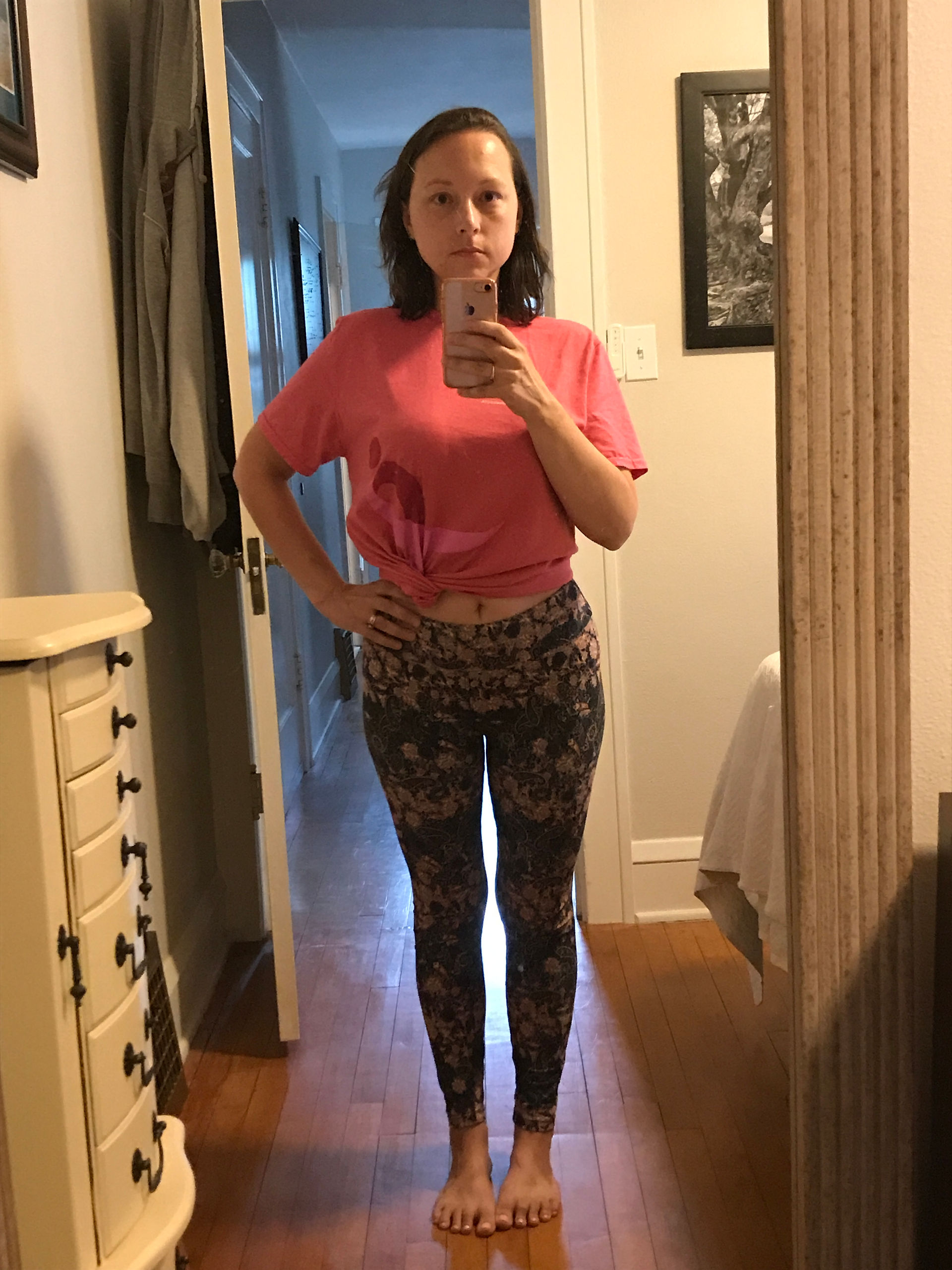 1-year post TG