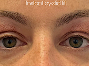 Get Glowing with 30% Off Nanozelle Plasma Skin Tightening– Limited Time Offer!