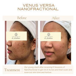 My patient received 1.2 mp of Versa to plump her lips and remove fine lines. - 7