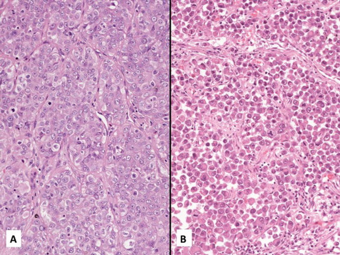 large cell carcinoma.jpg