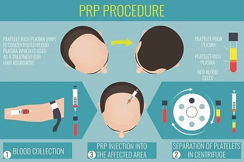 PRP-infographic2-1920w.webp