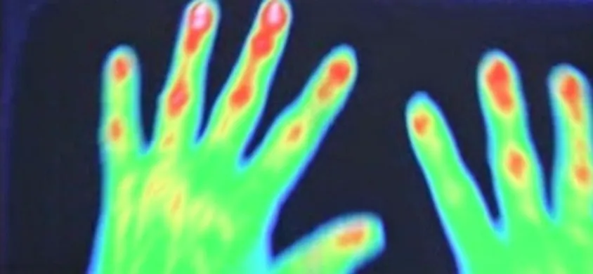 Rheuma im Finger? Hand unterm Rheumaccan | chronischgutleben.com