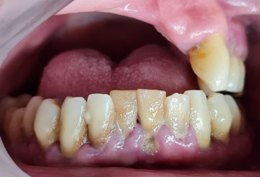 Doença periodontal