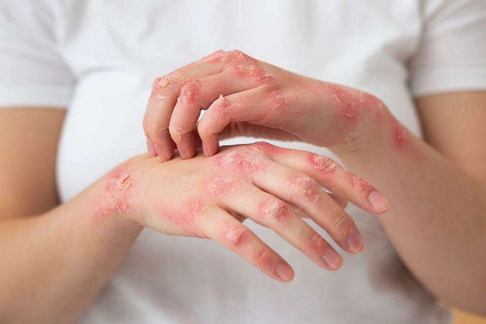 Ayurvedic Treatment for Psoriasis in Chennai: A Natural Approach to Skin Healing