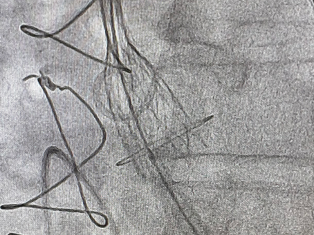 💓 “Valve-in-Valve”: uma nova chance para o coração bater com mais força