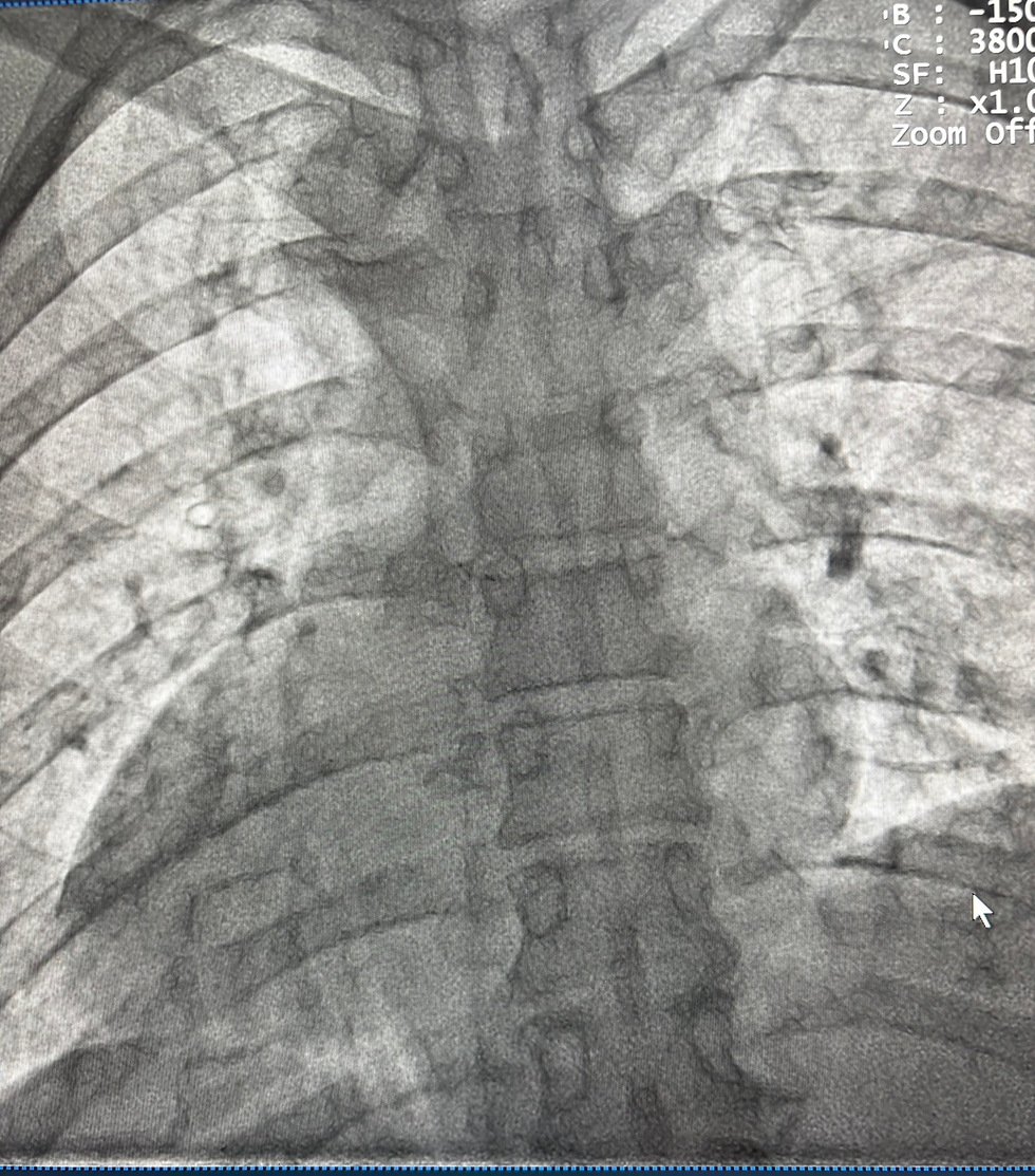 🫀✨ Quando o coração bate do lado direito: o que é Dextrocardia e Situs Inversus Totalis?