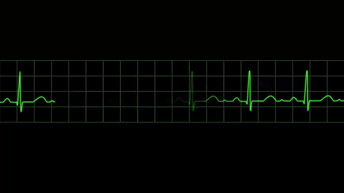 ecg.gif