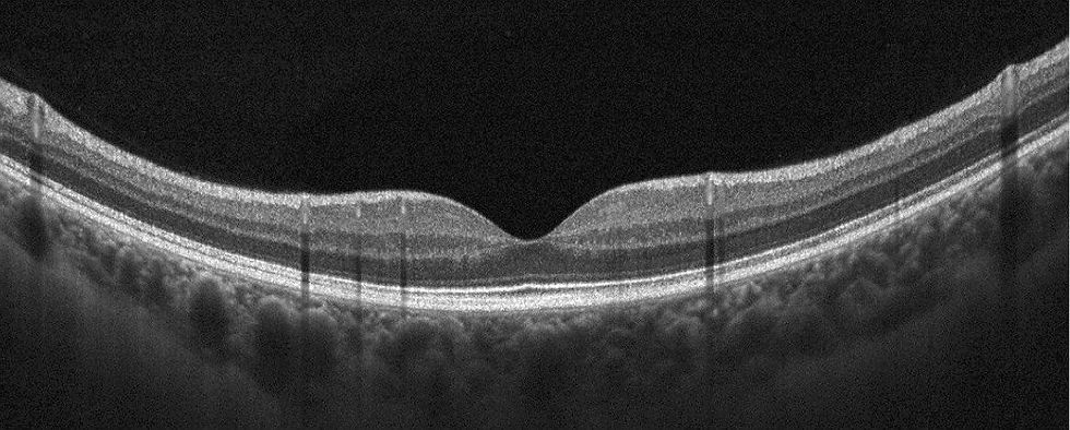 oct-normal-clinica-belfort.jpg
