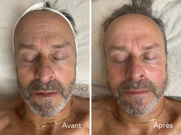 JetPeel homme avant/après