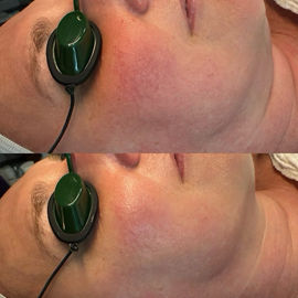 best facial for sensitive skin long island
