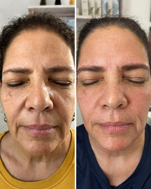 salmon dna facial in long island, ny
