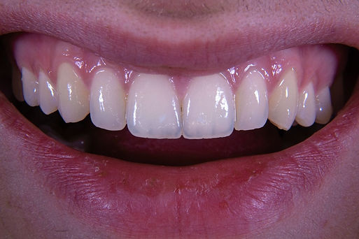 Faceta Dentária em Santo André