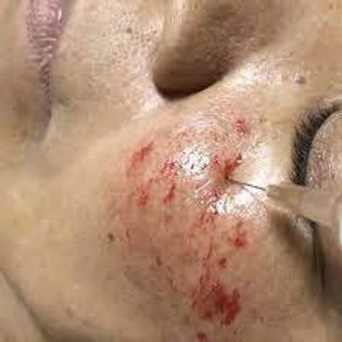 INTRADERMOTERAPIA PARA MELASMA