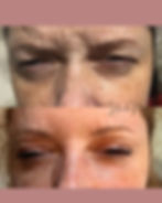 Miniatura: BOTOX 3 REGIÕES + PREENCHIMENTO