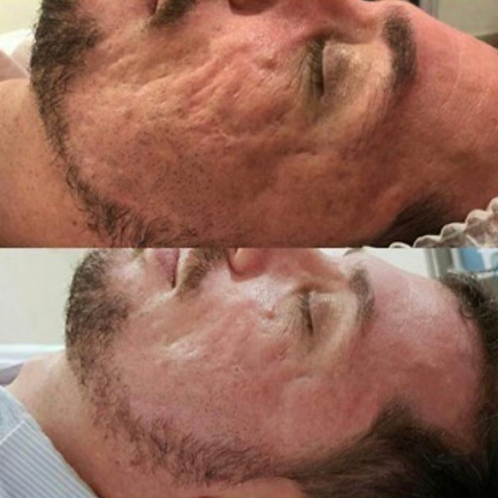 PEELING 3D