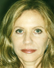 Restylane After