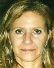 Restylane Before