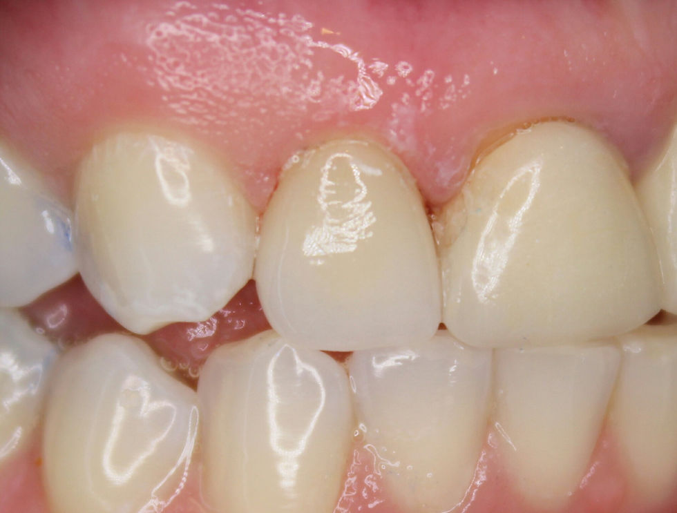 Perfect front tooth