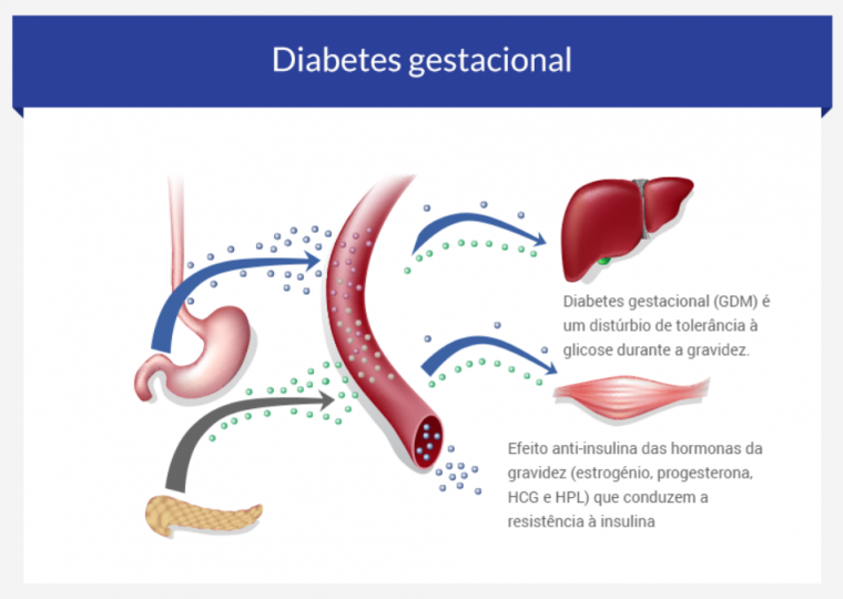 Diabetes gestacional, entenda tudo e saiba como se prevenir