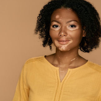 O impacto emocional do vitiligo: dicas de saúde mental para ajudar a enfrentar esse desafio