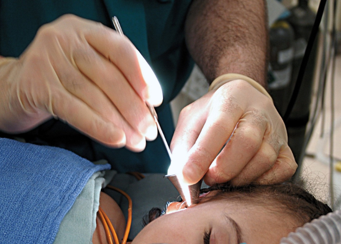 Cirurgia da Doença de Menière com Descompressão do Saco Endolinfático