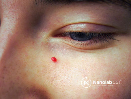 “Lunares rojos” y espirales doradas en los ojos que esconden una enfermedad rara: Todo sobre la enfermedad de Fabry