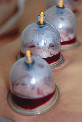 healing-bloodletting-hijama-phlebotomy-hajam-master-conducts-cupping-therapy-young-woman-i