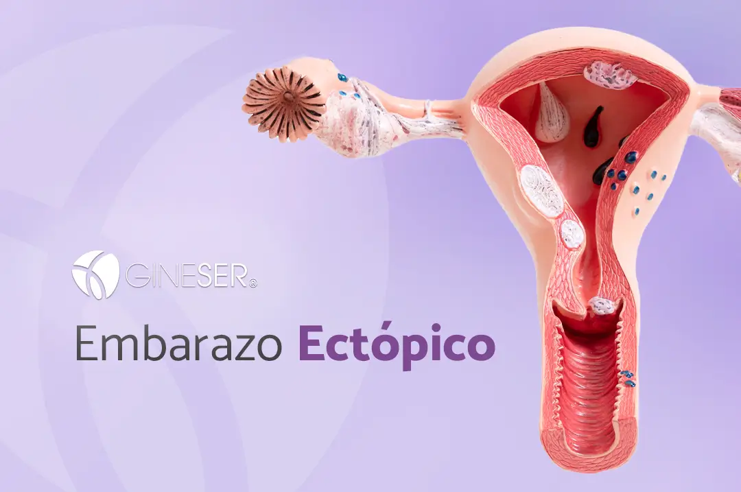 Embarazo Ectópico