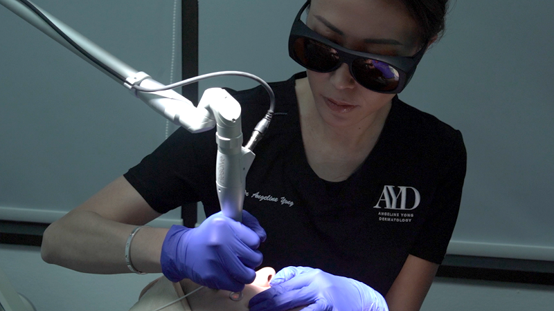 PicoWay or PicoSure for melasma removal | Dermatologist in Singapore
