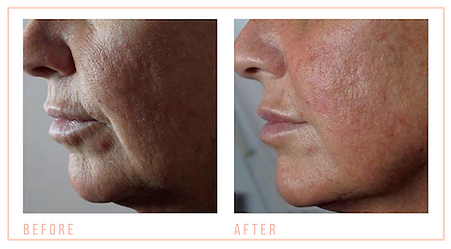 Before and after Jowl Lift 1.png