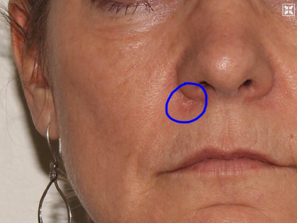 GETTING THE DIAGNOSIS OF SKIN CANCER NOW WHAT 