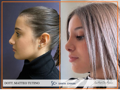 RINOPLASTICA SEMPLICE