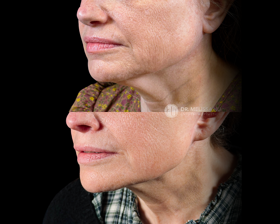 Copy of Rhinoplasty - Dr. Hu (1).png