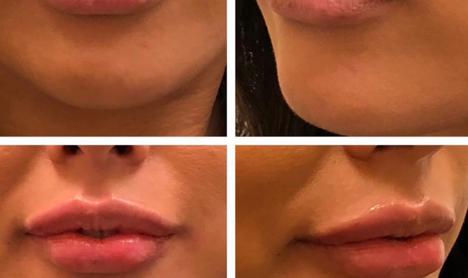 Lip filler