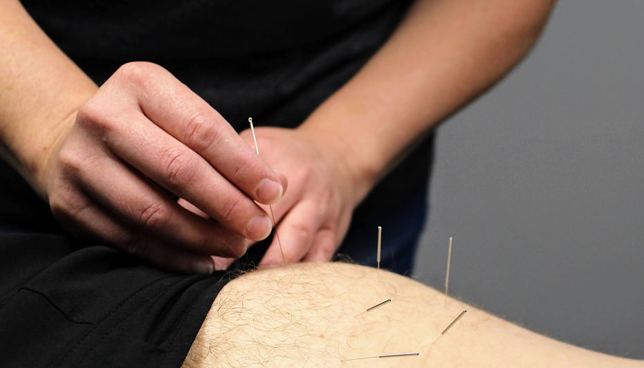 Acupuncture - Cordell Chiropractic Kansas