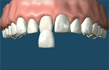 Veneers